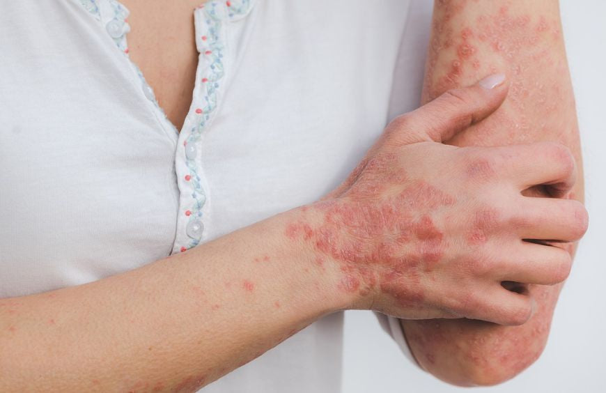 Si padece psoriasis, este artículo puede interesarle