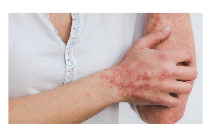 CBD y psoriasis: ¿hasta qué punto es eficaz?
